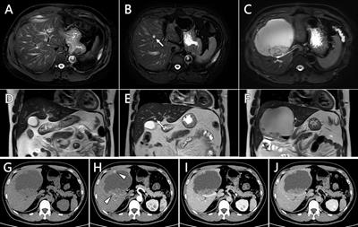 Case report: Rare isolated cystic hepatic metastasis of a patient with squamous cell lung carcinoma history and the prognosis